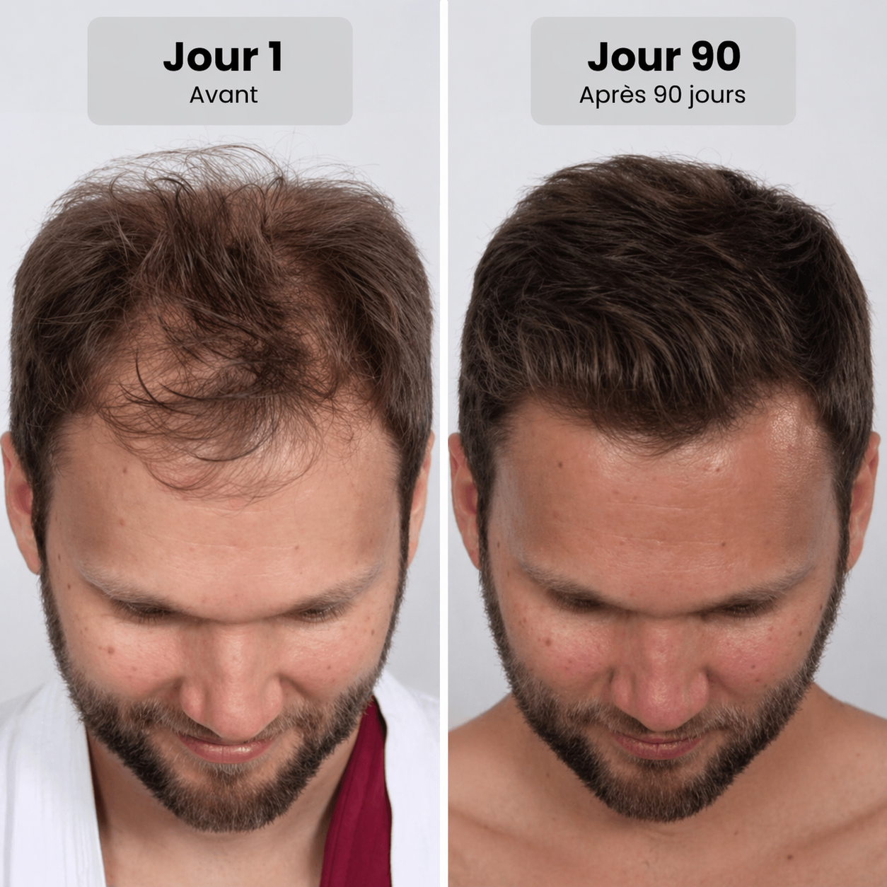 Casquette de thérapie par lumière rouge pour la repousse des cheveux