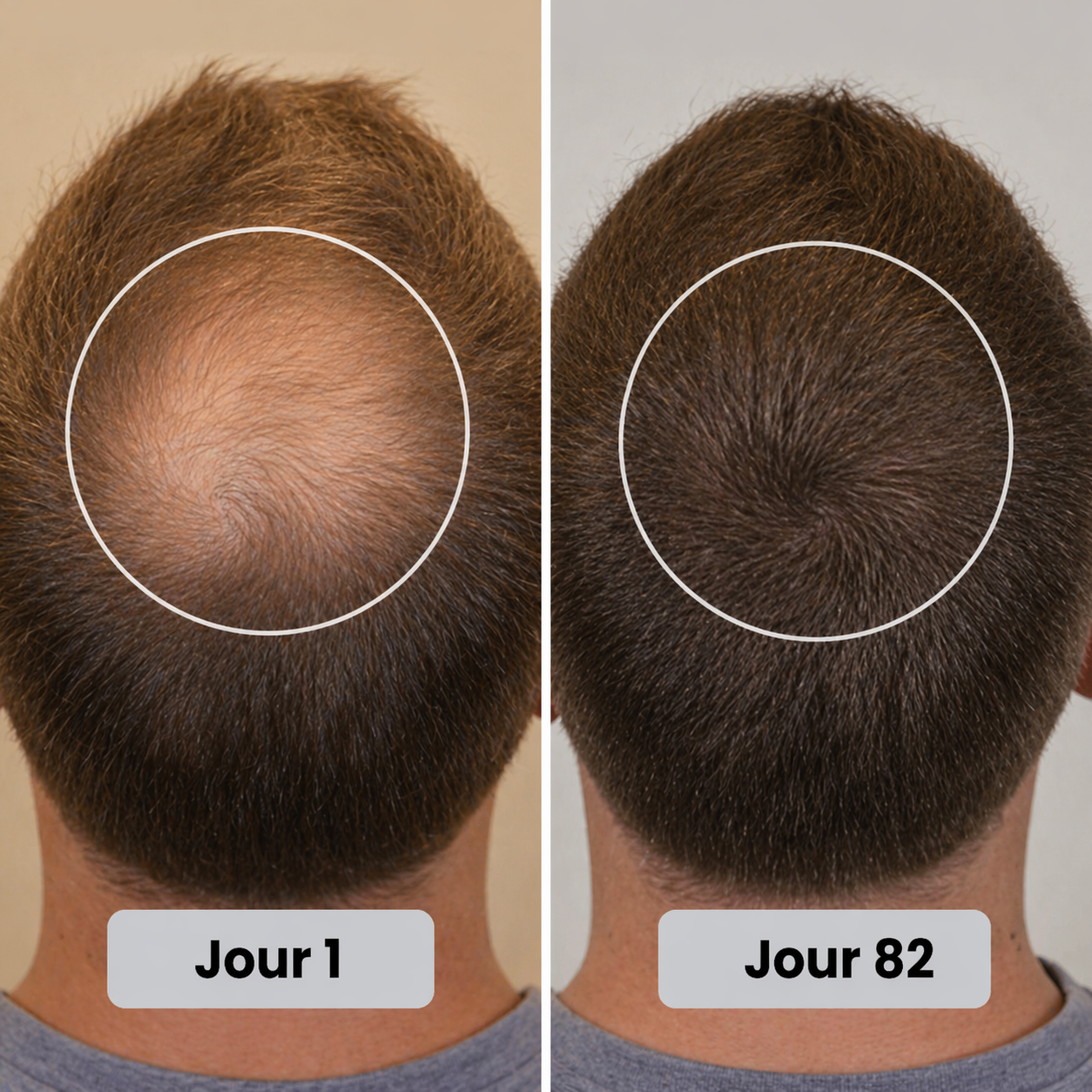 Casquette de thérapie par lumière rouge pour la repousse des cheveux