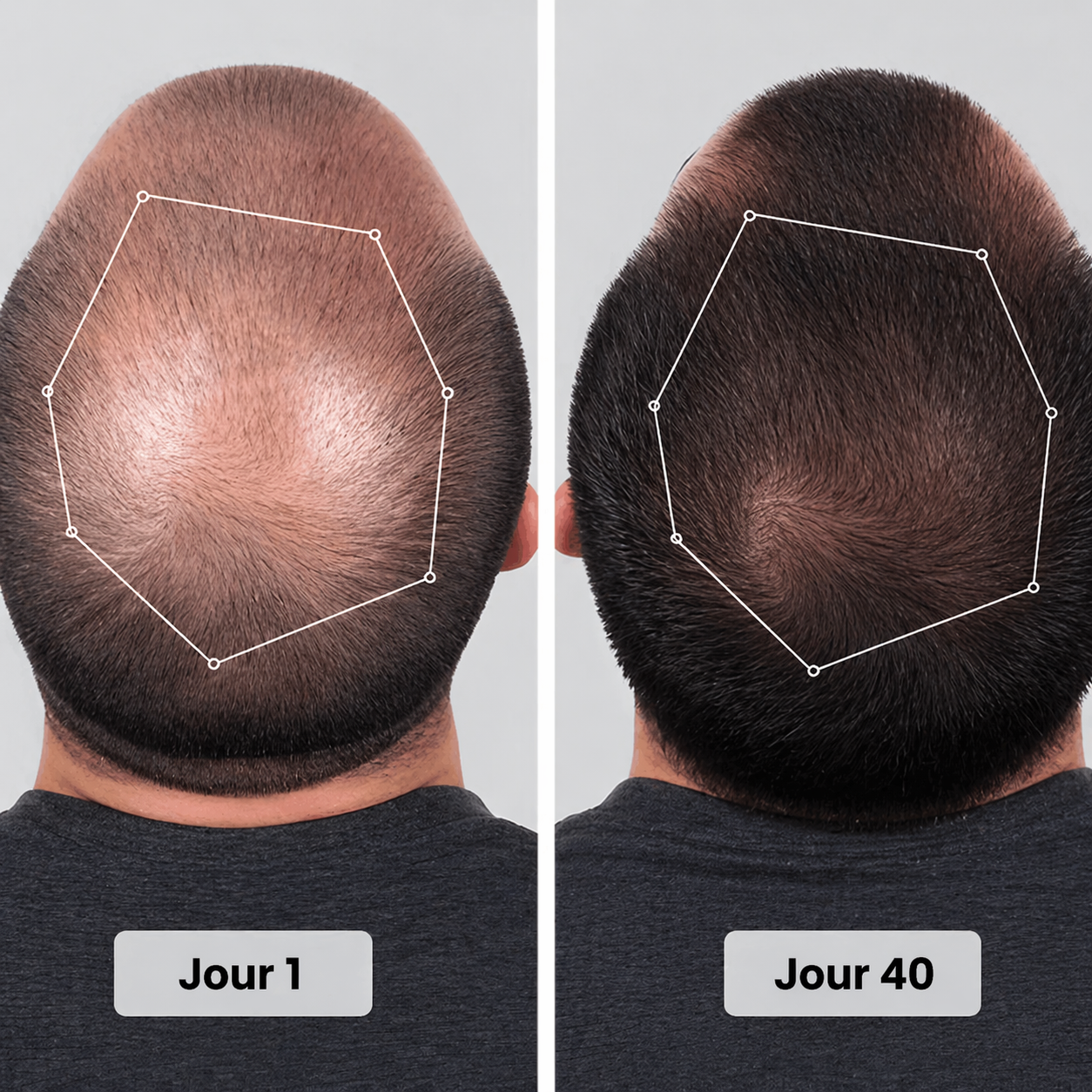 Casquette de thérapie par lumière rouge pour la repousse des cheveux