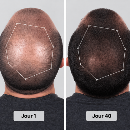 Casquette de thérapie par lumière rouge pour la repousse des cheveux