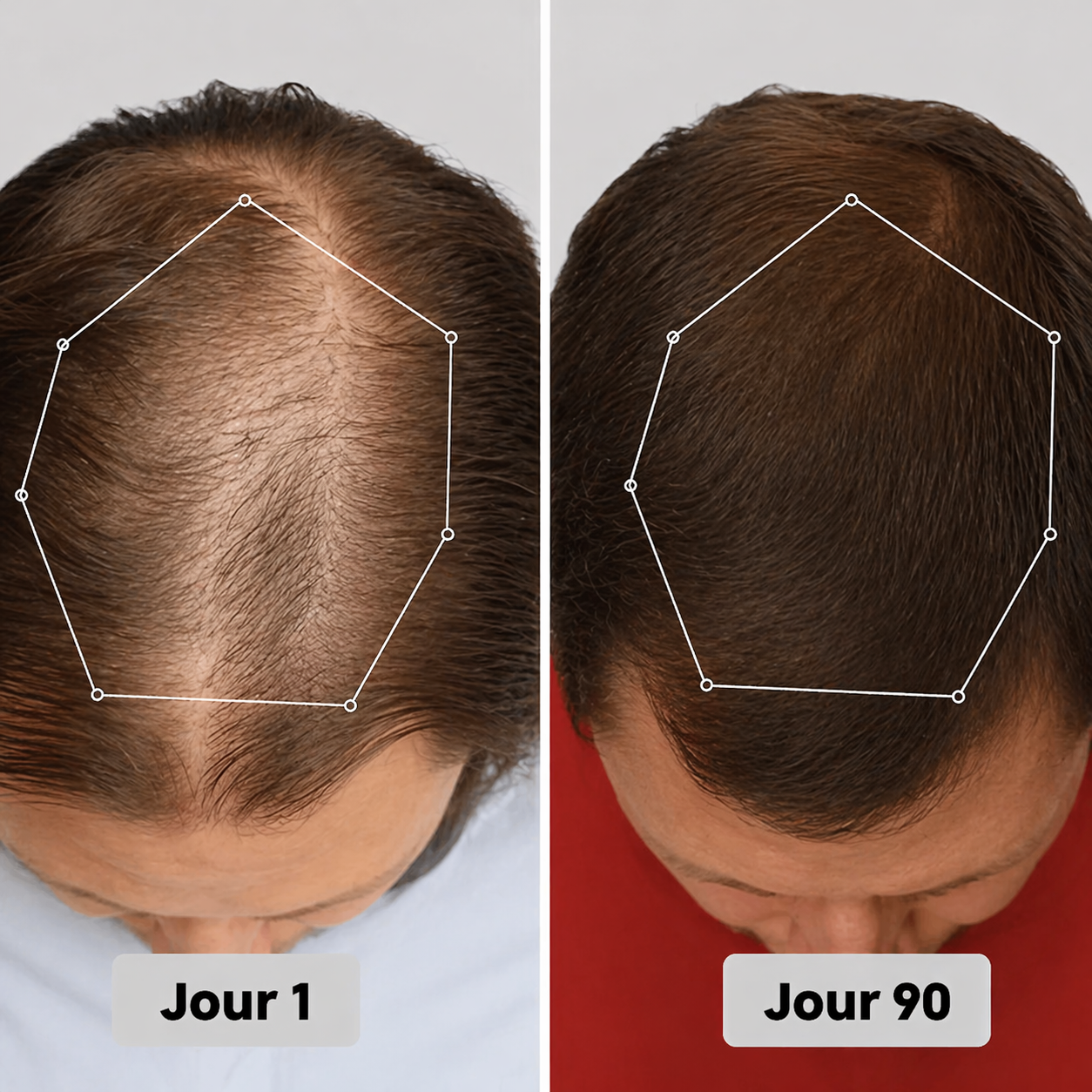 Casquette de thérapie par lumière rouge pour la repousse des cheveux